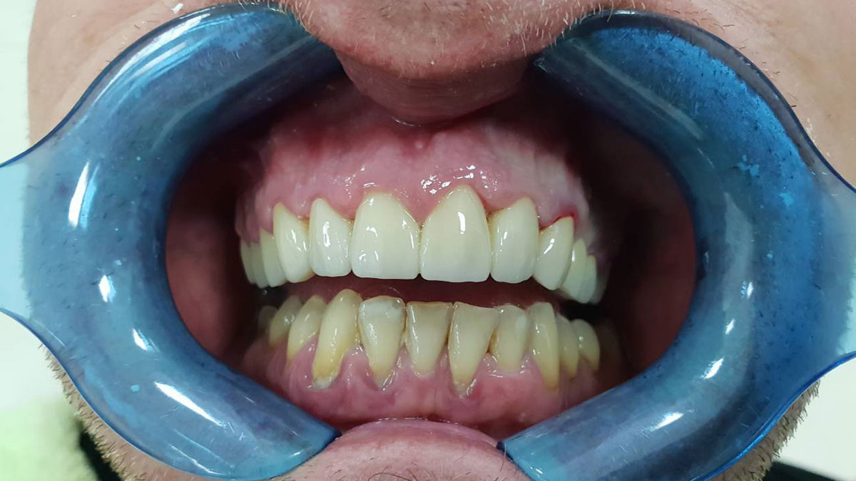 implantologija | slika zuba poslije implantologije 