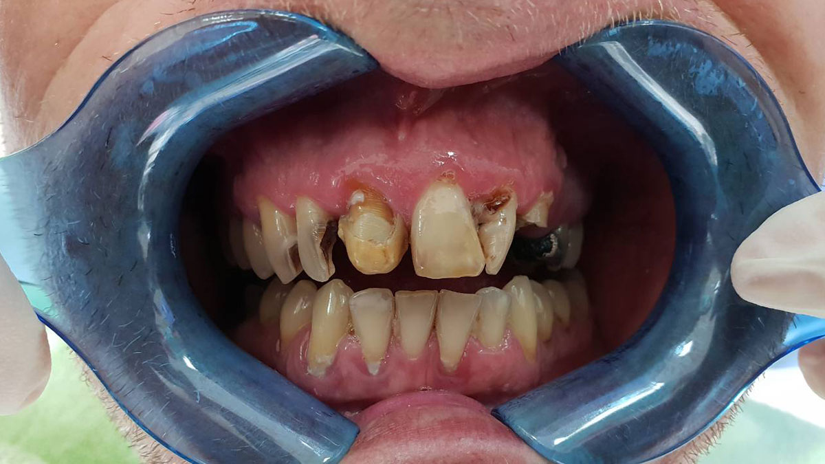 implantologija | slika zuba prije implantologije 